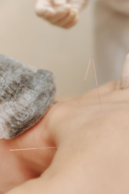 Dry needling